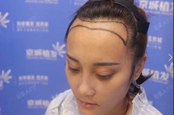 氧气xk9br种植发际线第1天美丽日记-新氧美容