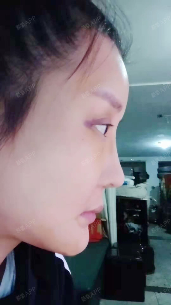 大琦儿自体脂肪全脸填充第3天美丽日记-新氧美