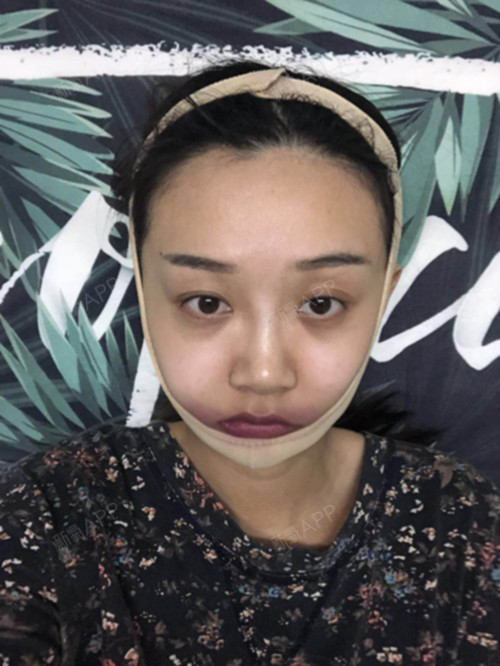 氧气1223681493898581下颌角整形第0天美丽