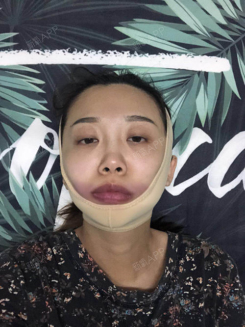 氧气1223681493898581下颌角整形第0天美丽