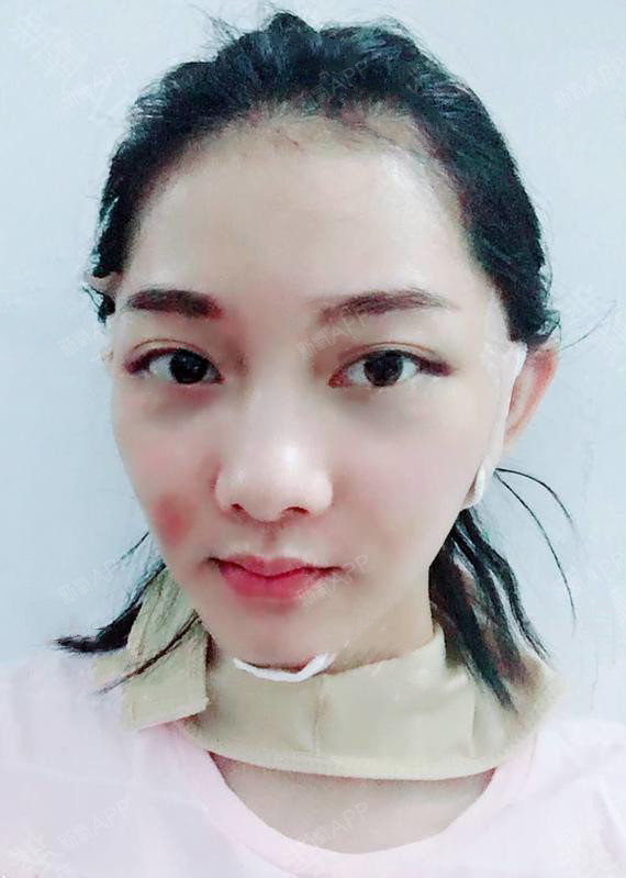 新氧- 月亮是被掰弯的 | 面部轮廓 | 面部吸脂 | 术后当自强 | 重庆