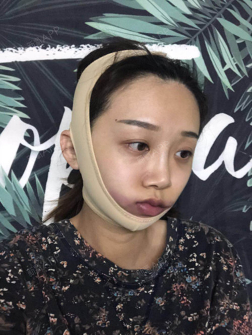 氧气1223681493898581下颌角整形第0天美丽