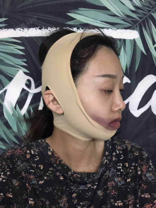 氧气1223681493898581下颌角整形第0天美丽