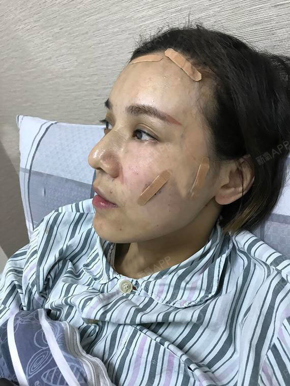 厌遇自体脂肪全脸填充第0天美丽日记-新氧美容