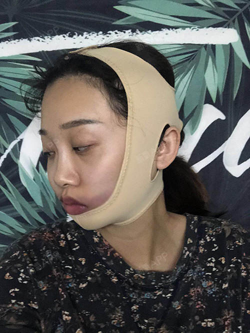 氧气1223681493898581下颌角整形第0天美丽