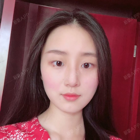 罗听华下颌角整形第76天美丽日记-新氧美容整