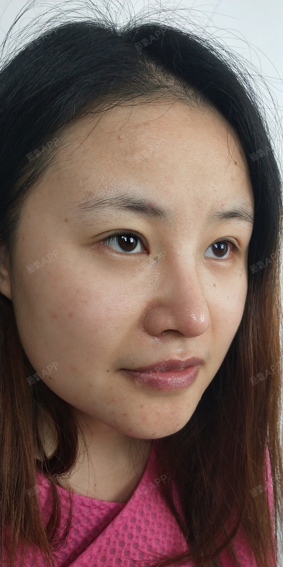 希天才呀切开双眼皮第0天美丽日记-新氧美容整