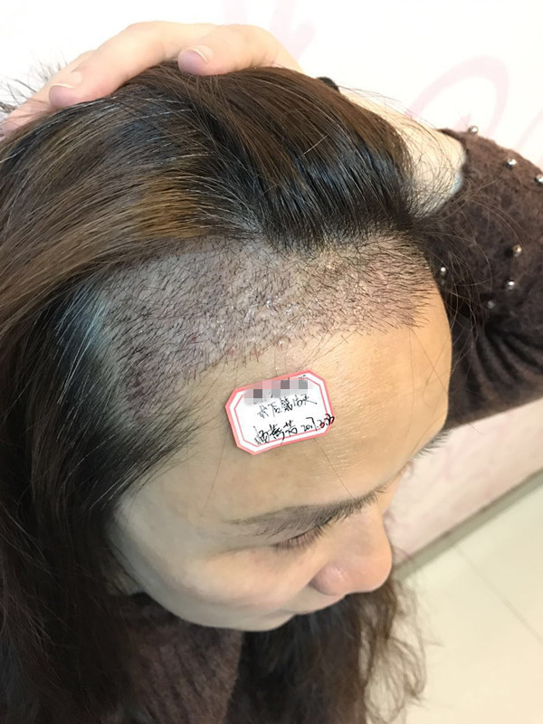 种植位置的头发已经长的密密麻麻了,三四厘米差不多有了吧,现在只用等