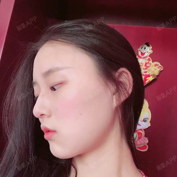 罗听华下颌角整形第76天美丽日记-新氧美容整