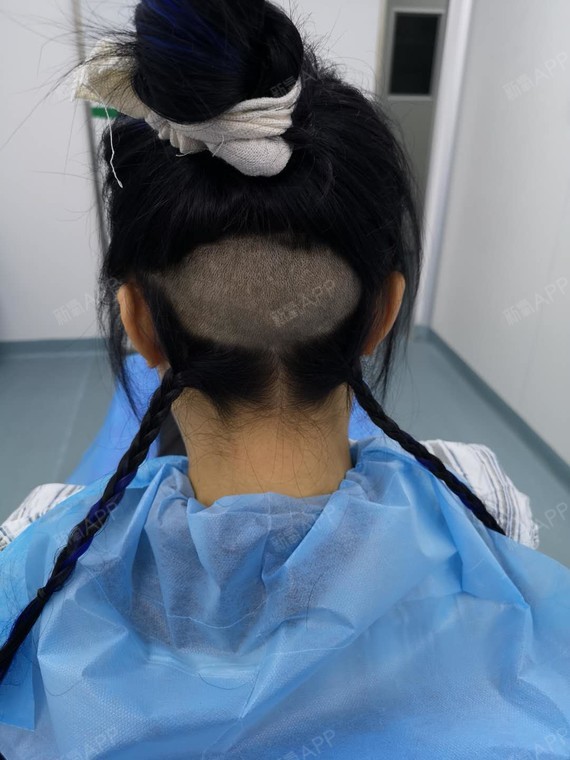 氧气2268131497268888种植发际线第0天美丽