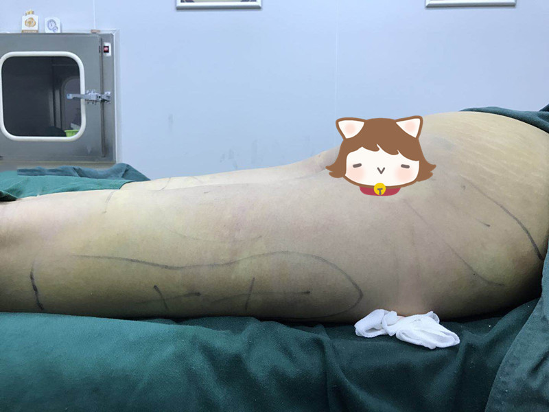 吸脂瘦全身怎么样_前后对比图_过程_氧气qpcd0a5整形.