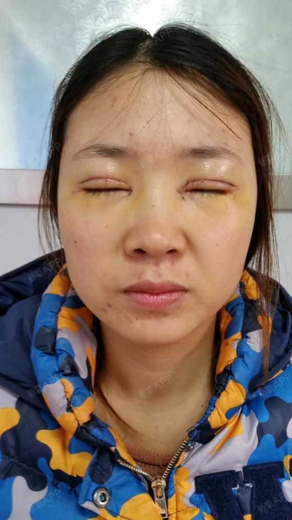 梦里开花啦啦开内眼角第3天美丽日记-新氧美容