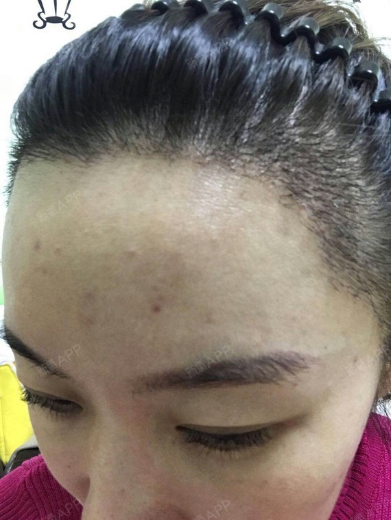 小月颖种植发际线第19天美丽日记-新氧美容整