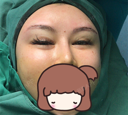 氧气1830881529894062假体垫眉弓第0天美丽