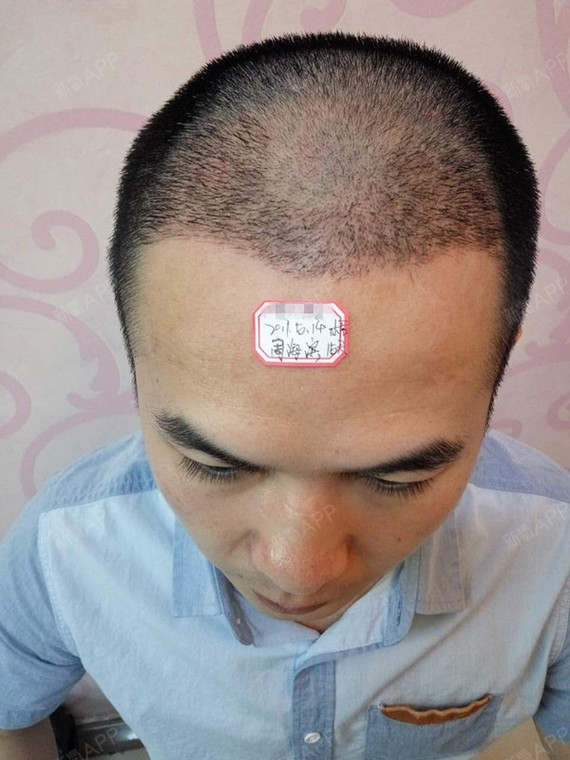 郑州欧兰植发头顶加密种植第14天美丽日记-新