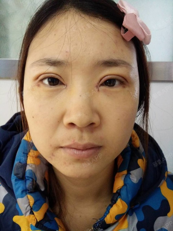 梦里开花啦啦开内眼角第3天美丽日记-新氧美容