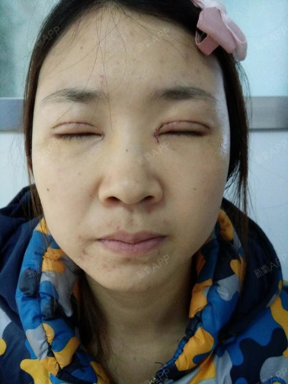 梦里开花啦啦开内眼角第3天美丽日记-新氧美容