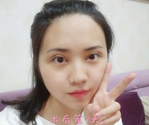 切开双眼皮