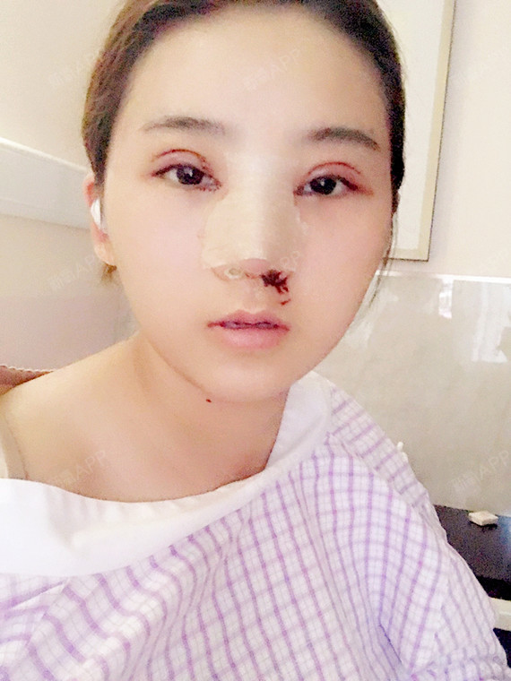 呼吸的37度鼻综合第2天美丽日记-新氧美容整形