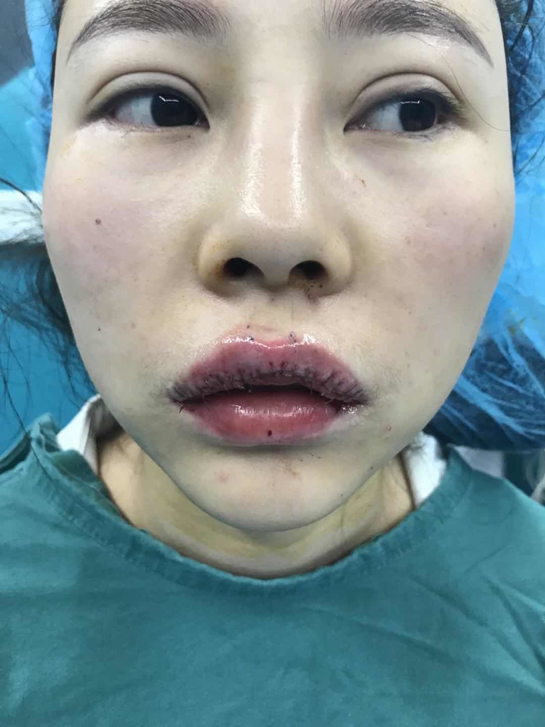 m唇手术第4天