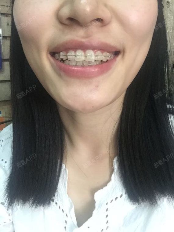 赵女士牙齿矫正有9个月了,门牙变化很大,效果明显!