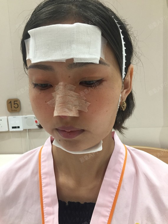 吓一跳鼻综合第3天美丽日记-新氧美容整形