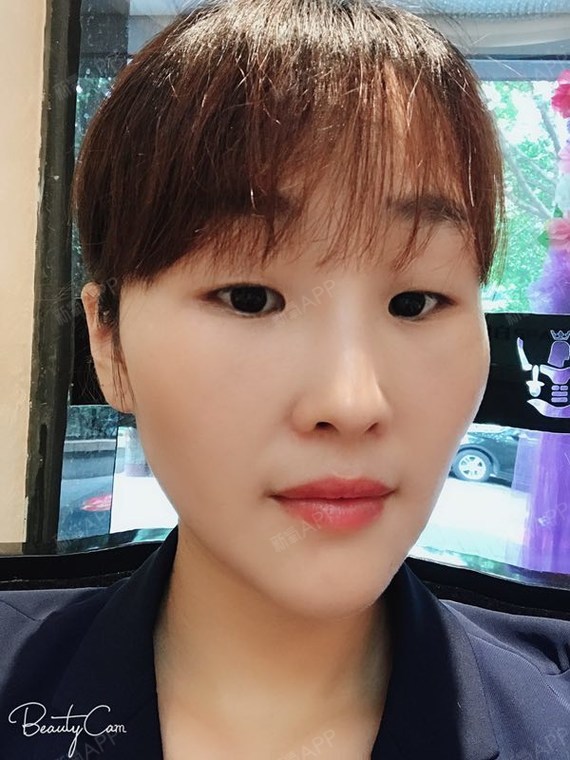 夏天的风正暖暖吹过内切去眼袋第15天美丽日