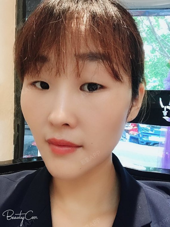 夏天的风正暖暖吹过内切去眼袋第15天美丽日