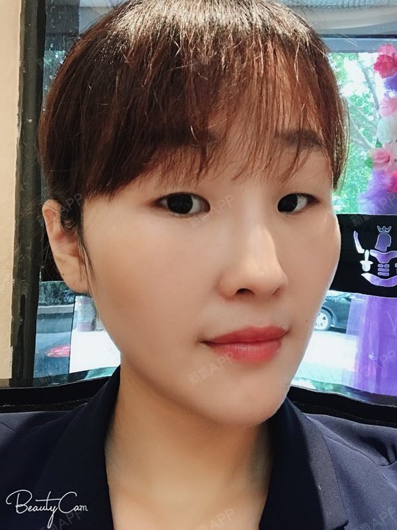 夏天的风正暖暖吹过内切去眼袋第15天美丽日