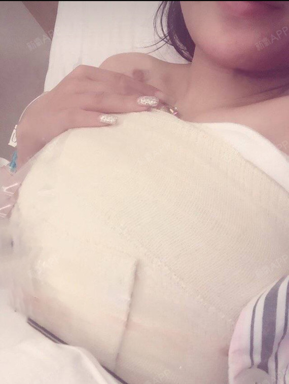 【长沙悦美整形自体脂肪丰胸】思来想去决定还是通过做自体脂肪