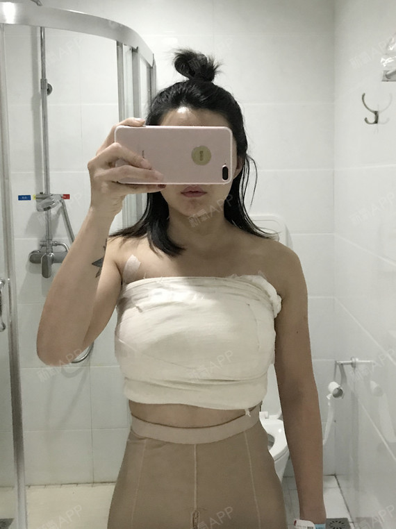 假体隆胸