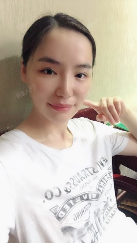 玲琅满目埋线提升第20天美丽日记-新氧美容整