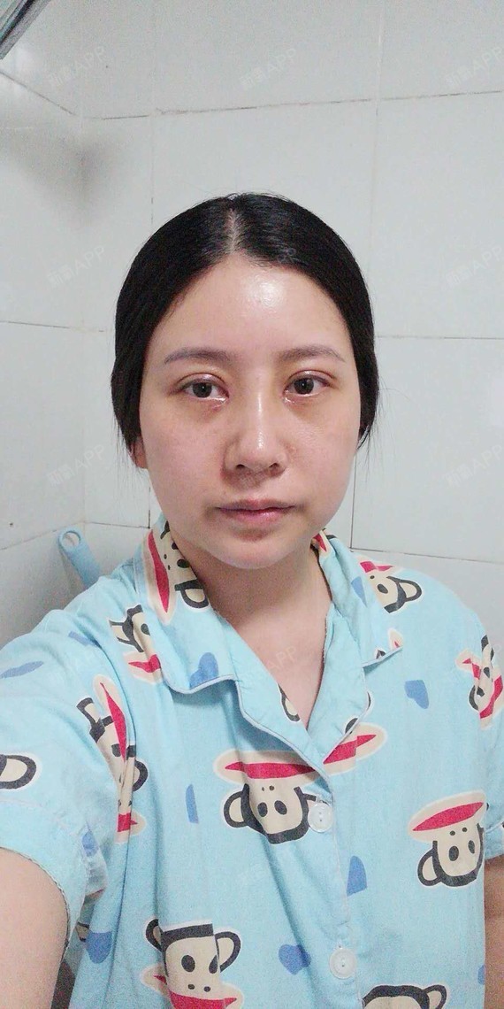重庆切开双眼皮好不好_效果图_娜就一个人22切开双术