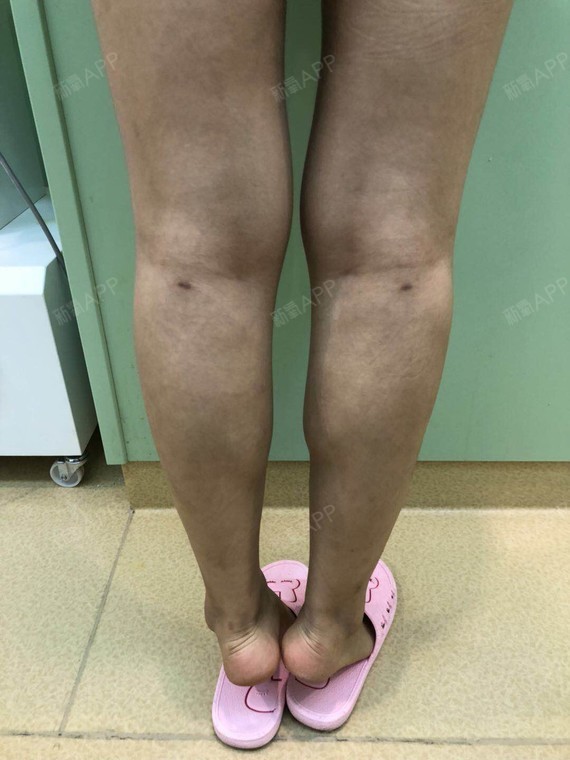 新氧 大象腿小月o 美体塑形 吸脂瘦大腿 术后当自强 成都