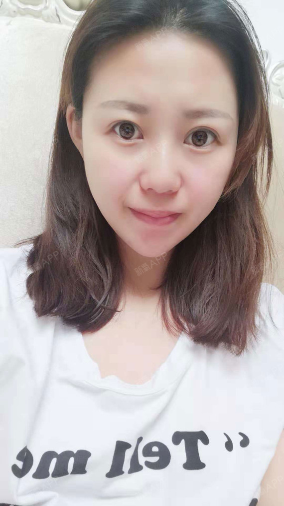 阁楼里的小花面部吸脂第30天美丽日记-新氧美