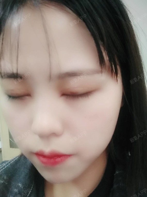 重庆埋线双眼皮好不好_效果图_鲨鱼仔z埋线双眼皮术后