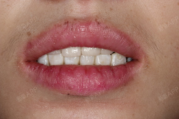 新氧 - 无长相 | 牙齿 | 术后当自强 | 鹤岗同城 | 补