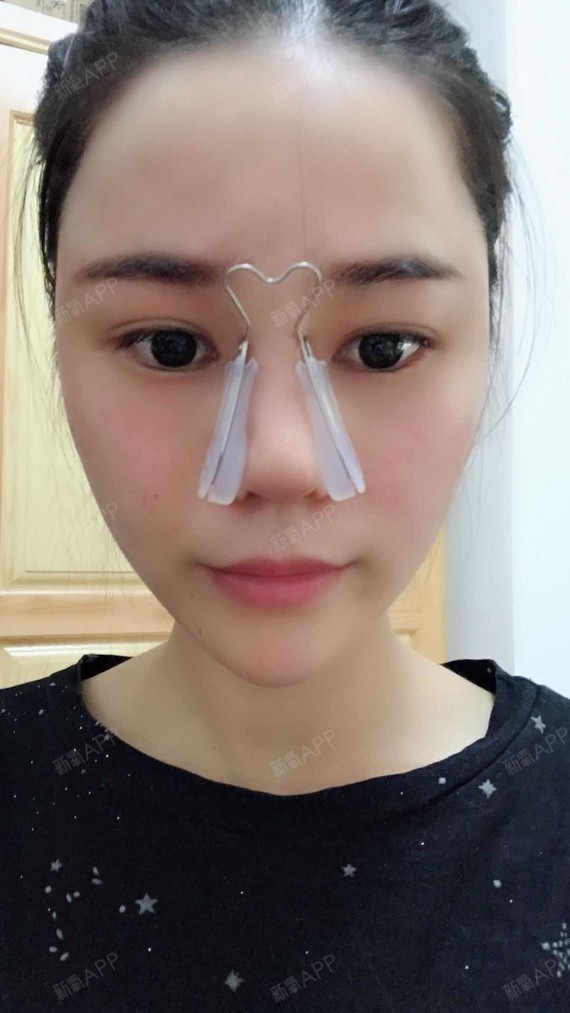 前几天,鼻子还是用鼻夹固定着的,现在已经拆掉了,鼻子的形状大家可以
