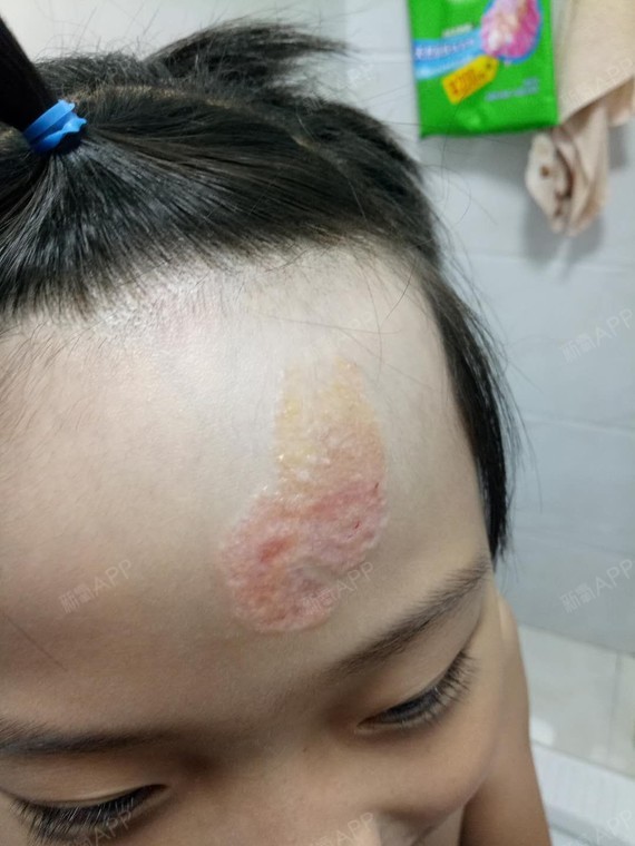 上一次点得皮脂腺痣现在到了掉痂期了,我女儿说痒天天