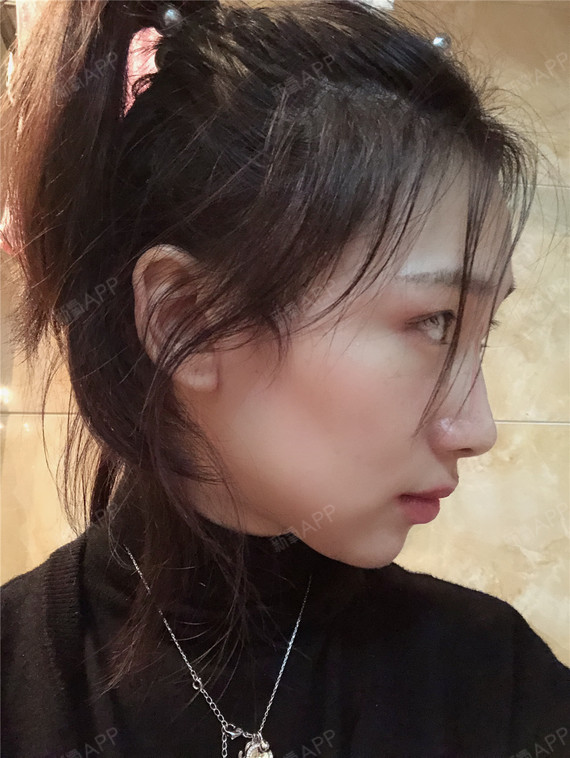 下颌角整形