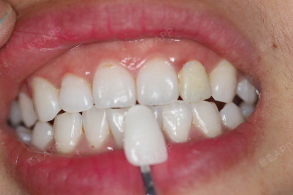 新氧 - 一个微暖的角落 | 牙齿 | 种植牙 | 术后当自