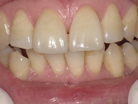 新氧 - 氧气y7tmm | 牙齿 | 种植牙 | 术后当自强