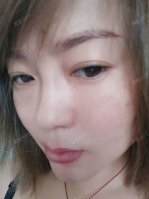 氧气9385941528328644激光去眼袋第14天美