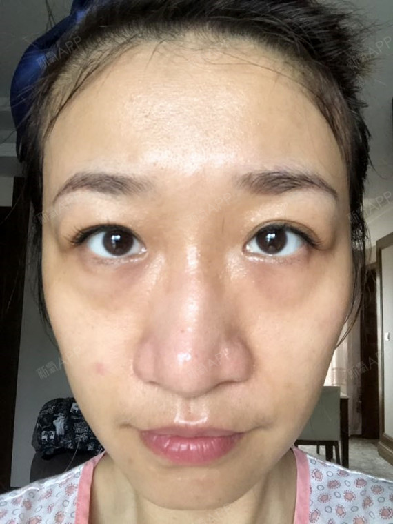 激光去黑眼圈