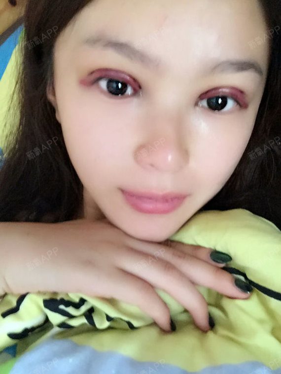 氧气x1neq定点双眼皮第3天美丽日记-新氧美容