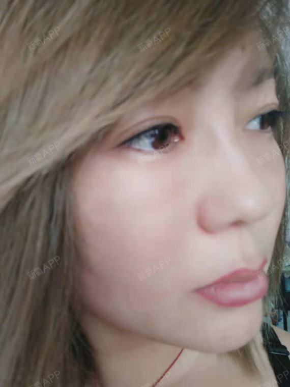 氧气9385941528328644激光去眼袋第14天美