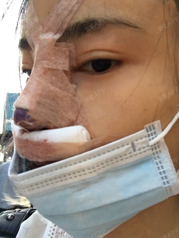 牛奶咖啡派宽鼻矫正第4天美丽日记-新氧美容整