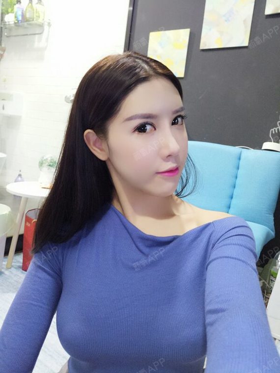 爱呀呀呀你是谁埋线提升第13天美丽日记-新氧