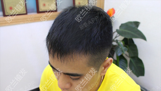 郑州欧兰植发头顶加密种植第138天美丽日记-新