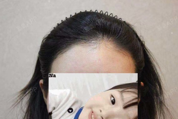 韩国moplus毛发移植医院种植发际线第0天美丽